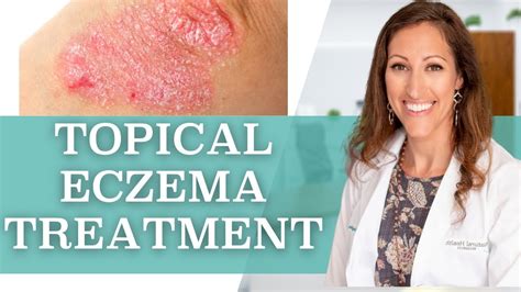 How To Treat Eczema Topically At Home Youtube