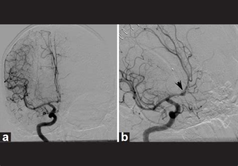 Figure 3acute Formation Of A Pseudoaneurysm Adjacent To A Previously