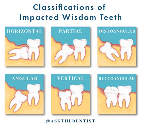Wisdom Teeth Pictures Symptoms Surgery And Pain Relief Ask The Dentist