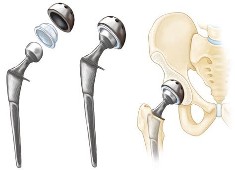 Best Hip Replacement Implant For Surgery Act Out Loud