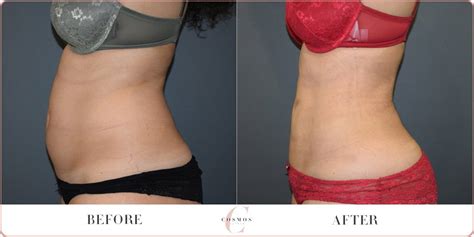 Female Tummy Liposuction Before After