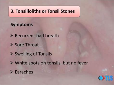 Sore Throat And Fever Strep Throat Symptoms Diagnosis And Treatment