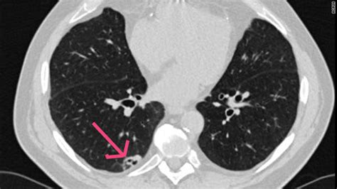 Ct Scans Show Promise For Lung Cancer Screening The
