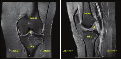Preoperative Mri Of The Patient With Acl Deficiency Of The Left Knee