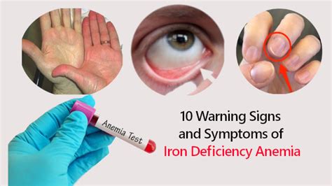 10 Warning Signs And Symptoms Of Iron Deficiency Anemia