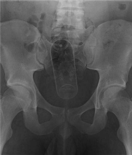 Management Of Rectal Foreign Bodies Description Of A New Technique And