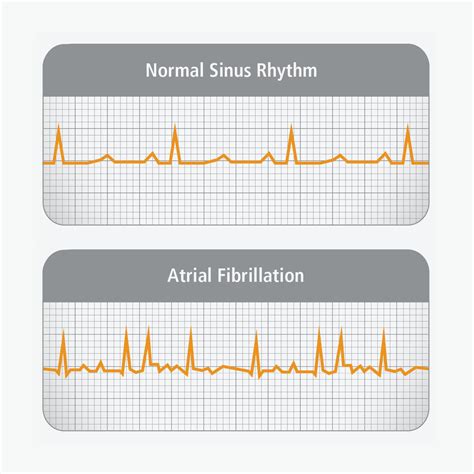 How Is Atrial Fibrillation Characterized