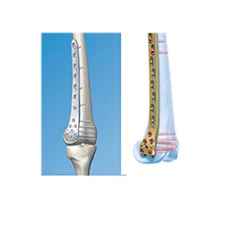 Innovative plate designs combined with the polyaxial ncb locking plate technology offer solutions for fixation of particularly complex periprosthetic fractures. Titanium Distal Femoral Locking Plate, Rs 6500 /unit Hib ...