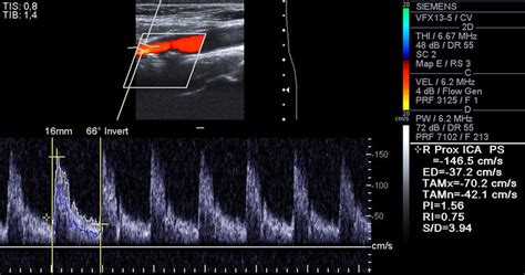 Carotid Artery Ultrasound