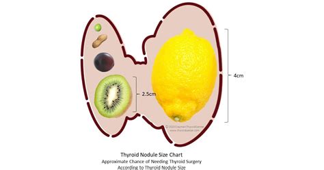 Renowned Surgeons Publish Thyroid Nodule Size Chart During Thyroid