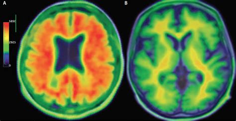 Neuroimaging And Alzheimers Disease Practical Neurology
