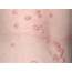 Bumps On Chest Small Red Rashes Acne Vulgaris And Not 