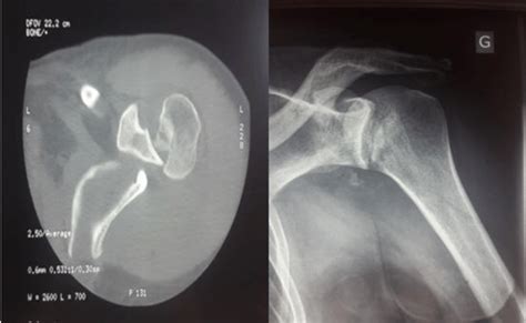 Radiograph And CT Scan Of The Left Shoulder Reveal Posterior Download Scientific Diagram