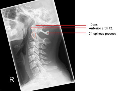 Alar Ligament Calcification Radiology Reference Article Radiopaedia Org