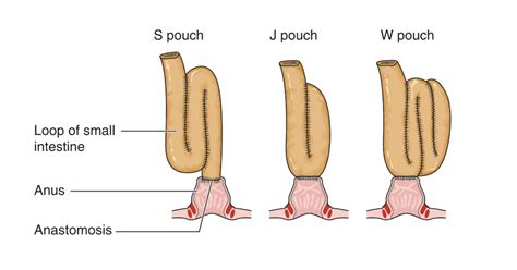 Check spelling or type a new query. Restorative proctocolectomy with ileo-anal pouch