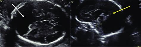 Axial Ultrasound Of A Dandy Walker Malformation Showing Communication