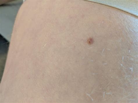 I Have This Mole On My Thigh The Discoloration Concerns Me I Have Had