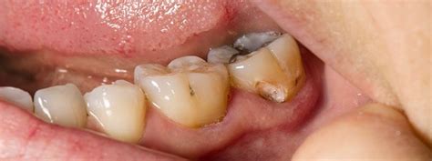 Abscessed Tooth Treatment Symptoms And Complications