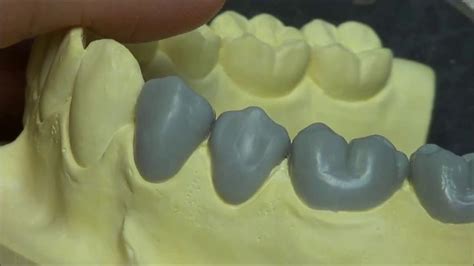 Live Wax Up Lower 2nd Premolar Full Wax Dental Art Dental