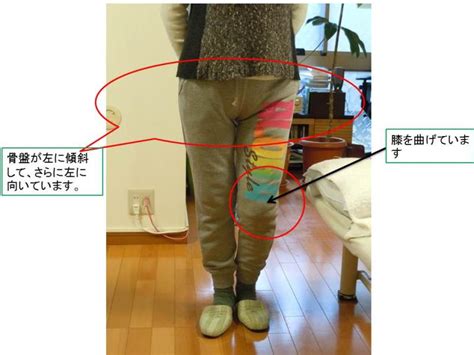 変形性股関節症―姿勢緊張ということ④ | WillLaboのブログ