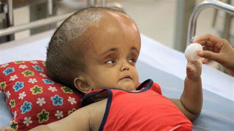 Baby With Swollen Head Hopes For Life Saving Surgery Born