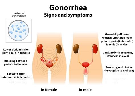 Check spelling or type a new query. What Is Gonorrhea | Gonorrhea Symptoms