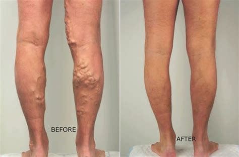 Most Latest Advance And Next Generation Treatment For Varicose Veins In