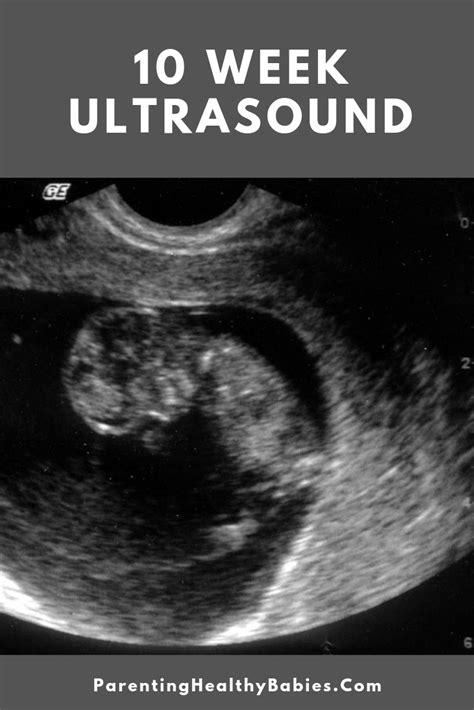 10 week ultrasound all you need to know as a new mom to be ultrasound gender prediction 10