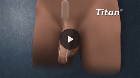 Penis Implant Telegraph