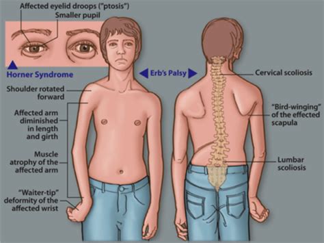 Erbs Palsy Pediatric Physical Therapy Brachial Plexus Physical