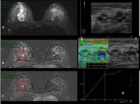 Figure 24 From Imaging Spectrum Of Breast Focal Fibrocystic Changes
