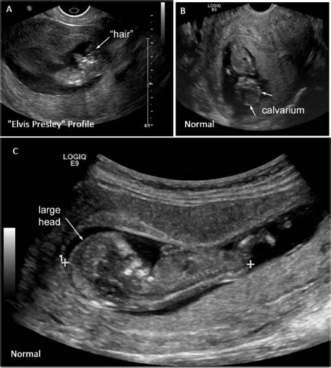 Anencephaly Ultrasound Findings