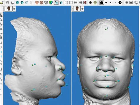 Facial Anthropometry Measurements Using Three Dimensional St Journal Of Craniofacial Surgery