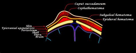 Metroscans Subgaleal Fluid Collection