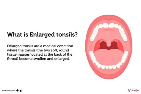 Enlarged Tonsils Causes Symptoms Treatment And Cost