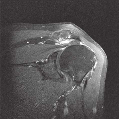 Subacromial Subdeltoid Bursitis Mri Radiology Video Radedasia My Xxx