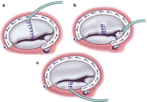 Surgical Techniques Of Tricuspid Valve Repair In Patients Without
