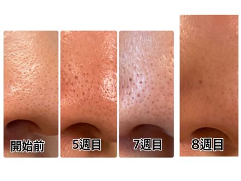 【ゼオスキン】開始から8週間の経過レポ♪皮剥けや赤みの様子 ...