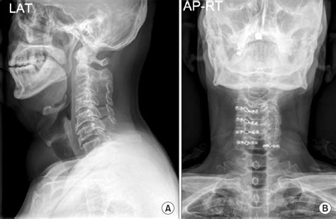 A Lateral View Of The Cervical Spine With Postoperative Spontaneous