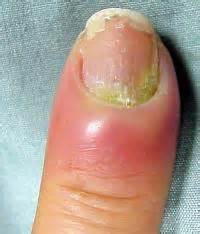 Πᾰρά — возле, около и ὄνυξ (gen. Paronychia - Inflamed Nail