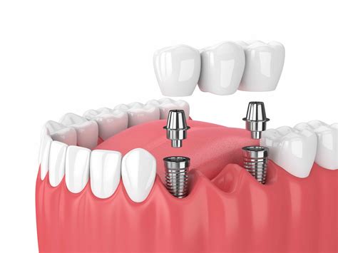 Woodland Hills Dentist Looks At What Type Of Dental Implant Your Smile