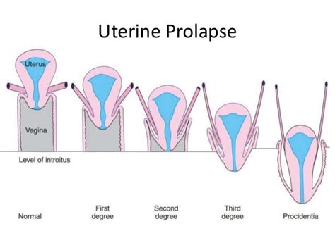 Utero Vaginal Prolapse By Sunil Kumar Daha