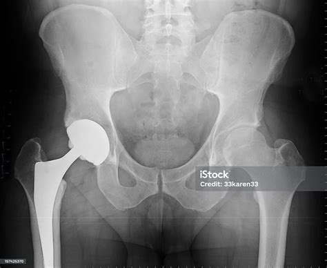 Xray Of Total Hip Arthroplasty Stock Photo Download Image Now Hip