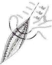 The horizontal mattress stitch is a suture technique used to close wounds. suturetypes