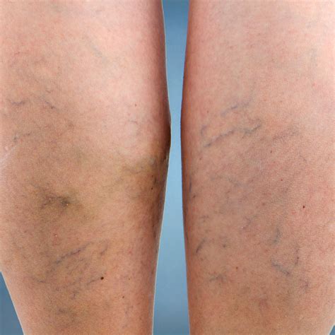 What Causes Bulging Leg Veins The Vein Center Of Maryland