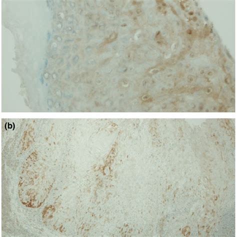 Pdf Aggressive Cutaneous Squamous Cell Carcinoma Arising From A Human