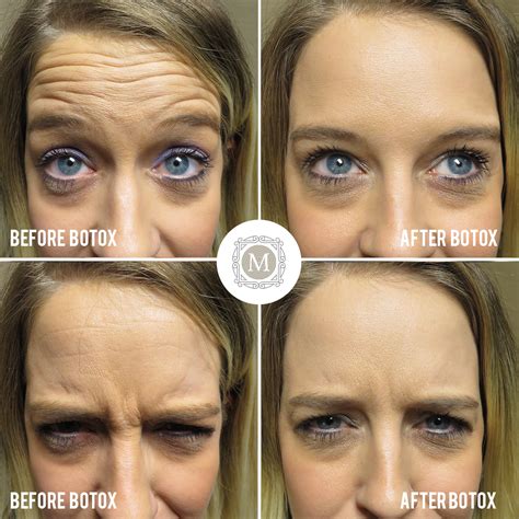 How many units of botox for forehead and eyes. This patient had 20 units of Botox for forehead wrinkles ...