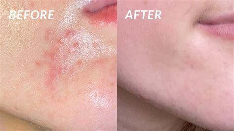 How I Completely Got Rid Of My Perioral Dermatitis In 4 Days The