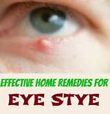 Home Remedies Eye Stye