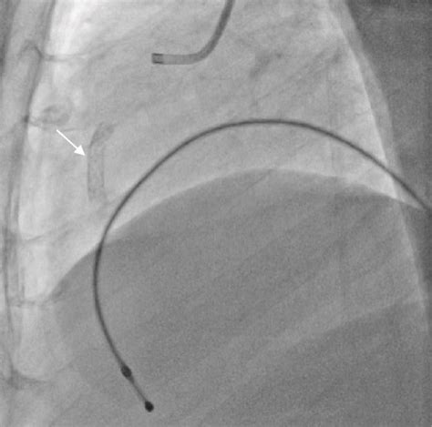 A Coronary Angiography Showing Rca In Lao Cranial View With Maximum